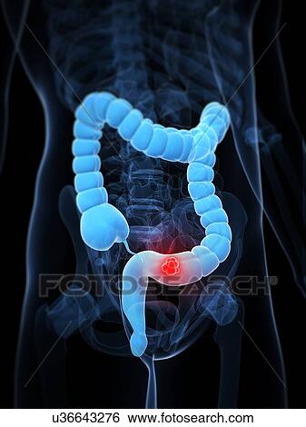 Colon cancer, artwork View Large Illustration Stock Illustration - Colon cancer, artwork. Fotosearch