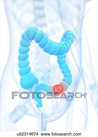 Stock Illustration - Colon cancer, artwork. Fotosearch