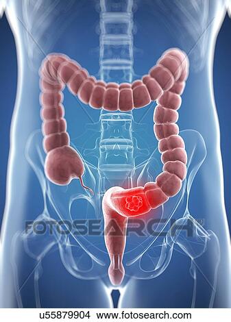 Colon cancer, artwork View Large Illustration Stock Illustration - Colon cancer, artwork. Fotosearch