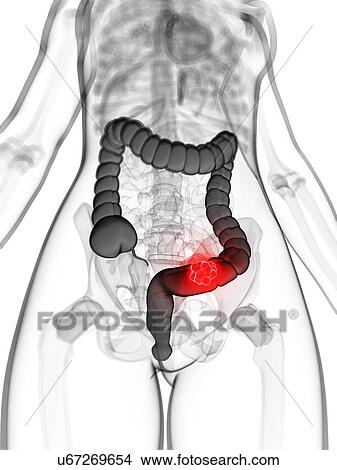 Colon cancer, artwork View Large Illustration Stock Illustration - Colon cancer, artwork. Fotosearch