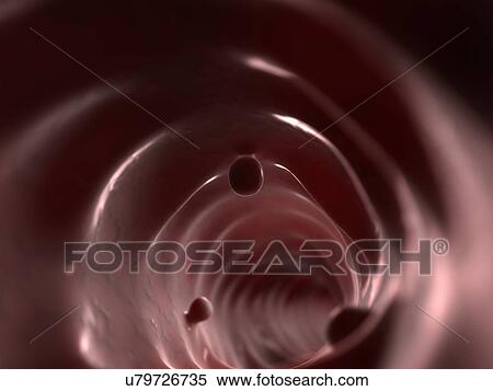 Colon polyps, artwork View Large Illustration Stock Illustration - Colon polyps, artwork. Fotosearch