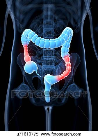 Colonic spasm, artwork View Large Illustration Stock Illustration - Colonic spasm, artwork. Fotosearch