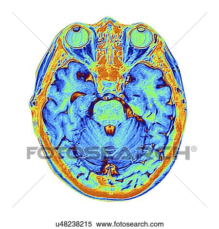 Stock Illustration - Coloured MRI scan of the human head. Fotosearch
