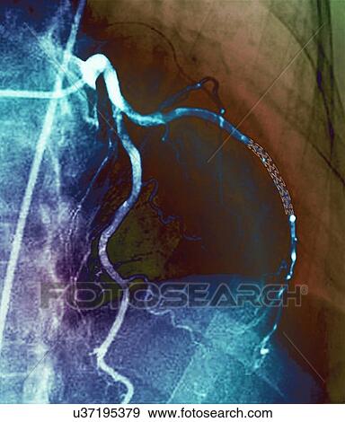 Coronary stent, X-ray View Large Illustration Stock Illustration - Coronary stent, X-ray. Fotosearch