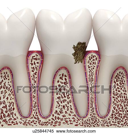 Dental plaque, artwork View Large Illustration Stock Illustration - Dental plaque, artwork. Fotosearch