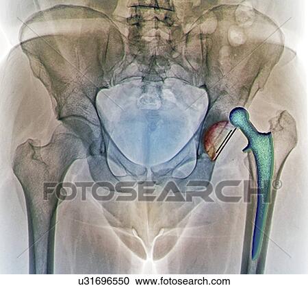 Dislocated hip replacement, X-ray View Large Illustration Clipart - Dislocated hip replacement, X-ray. Fotosearch