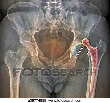 Stock Illustration - Dislocated hip replacement, X-ray. Fotosearch