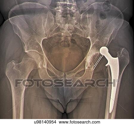 Stock Illustration - Dislocated hip replacement, X-ray. Fotosearch