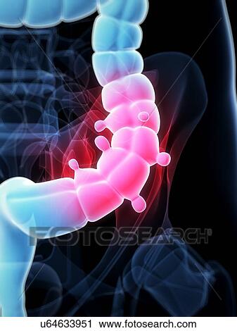 Diverticulosis, artwork View Large Illustration Clip Art - Diverticulosis, artwork. Fotosearch