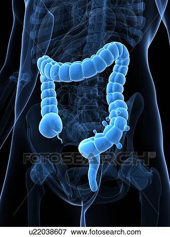 Diverticulosis, artwork View Large Illustration Stock Illustration - Diverticulosis, artwork. Fotosearch