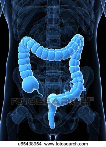 Diverticulosis, artwork View Large Illustration Stock Illustration - Diverticulosis, artwork. Fotosearch