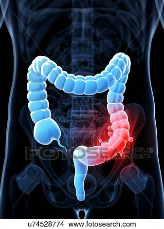 Diverticulosis, artwork View Large Illustration Stock Illustration - Diverticulosis, artwork. Fotosearch
