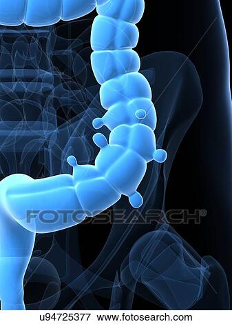 Diverticulosis, artwork View Large Illustration Stock Illustration - Diverticulosis, artwork. Fotosearch
