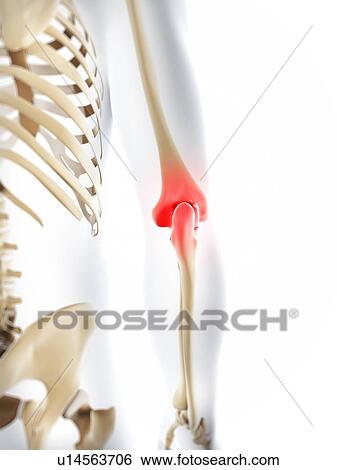 Elbow pain, conceptual artwork View Large Illustration Stock Illustration - Elbow pain, conceptual artwork. Fotosearch
