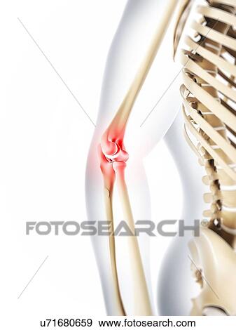 Elbow pain, conceptual artwork View Large Illustration Stock Illustration - Elbow pain, conceptual artwork. Fotosearch