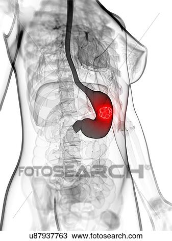 female stomach cancer View Large Illustration Drawing - female stomach cancer. Fotosearch