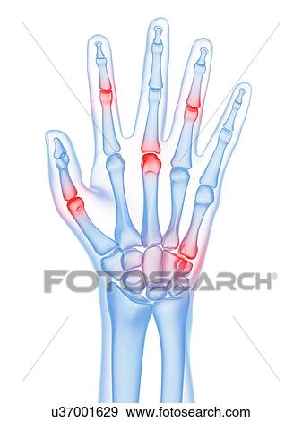 Hand joint pain, conceptual artwork View Large Illustration Stock Illustration - Hand joint pain, conceptual artwork. Fotosearch