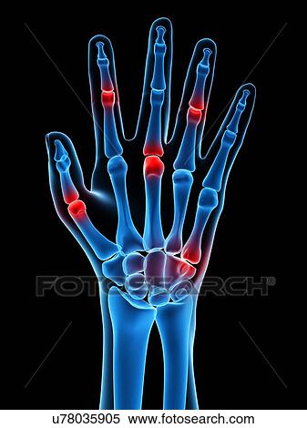 Stock Illustration - Hand joint pain, conceptual artwork. Fotosearch