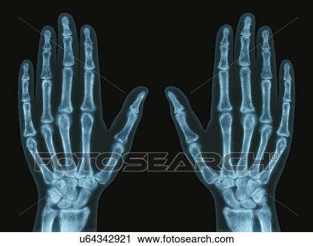 Hands, X-ray View Large Illustration Clip Art - Hands, X-ray. Fotosearch