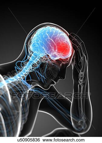 Stock Illustration - Headache, artwork. Fotosearch