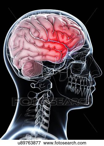 Stock Illustration - Headache, artwork. Fotosearch
