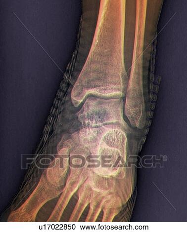 Healthy ankle joint, X-ray View Large Illustration Clipart - Healthy ankle joint, X-ray. Fotosearch