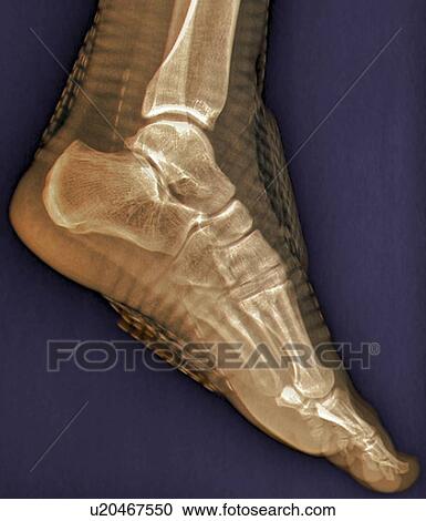 Clipart - Healthy ankle joint, X-ray. Fotosearch