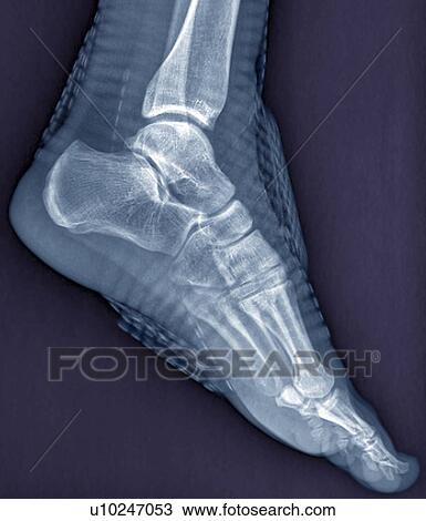 Drawing - Healthy ankle joint, X-ray. Fotosearch
