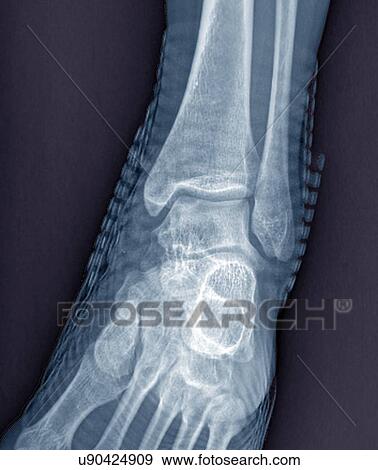 Healthy ankle joint, X-ray View Large Illustration Stock Illustration - Healthy ankle joint, X-ray. Fotosearch