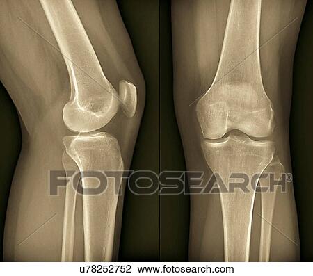 Drawing - Healthy knee, X-ray. Fotosearch
