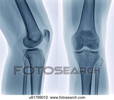 Drawing - Healthy knee, X-ray. Fotosearch