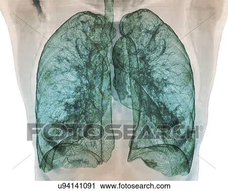 Clip Art - Healthy lungs, 3D CT scan. Fotosearch