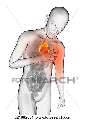 Clip Art - Heart attack, artwork. Fotosearch