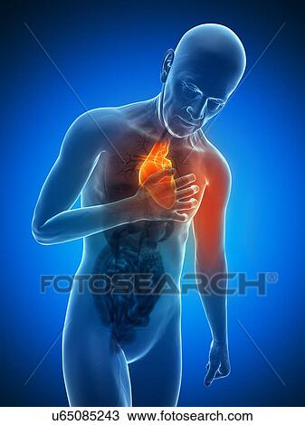 Drawing - Heart attack, artwork. Fotosearch