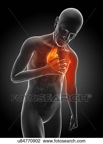 Drawing - Heart attack, artwork. Fotosearch