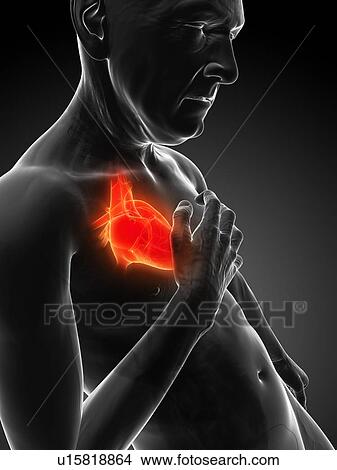 Stock Illustration - Heart attack, artwork. Fotosearch
