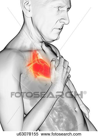 Heart attack, artwork View Large Illustration Stock Illustration - Heart attack, artwork. Fotosearch