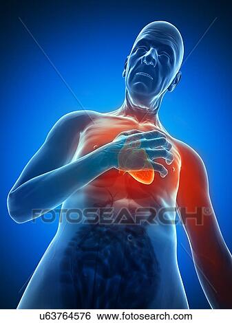 Heart attack, artwork View Large Illustration Stock Illustration - Heart attack, artwork. Fotosearch