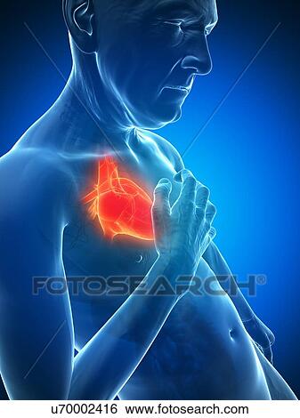 Stock Illustration - Heart attack, artwork. Fotosearch