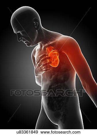 Stock Illustration - Heart attack, artwork. Fotosearch