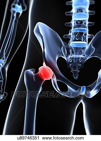 Clip Art - Hip pain, conceptual artwork. Fotosearch