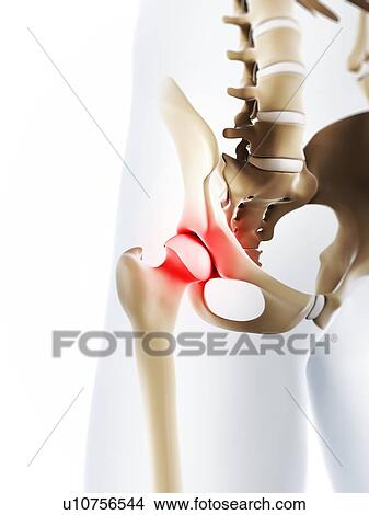 Stock Illustration - Hip pain, conceptual artwork. Fotosearch