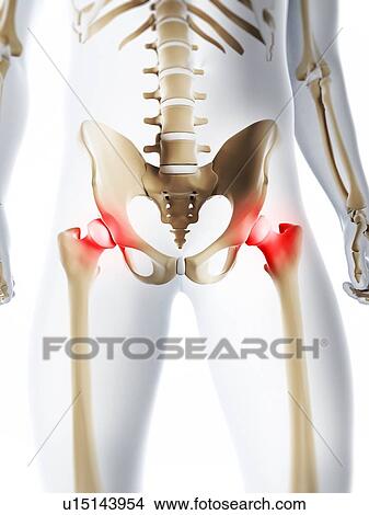 Stock Illustration - Hip pain, conceptual artwork. Fotosearch