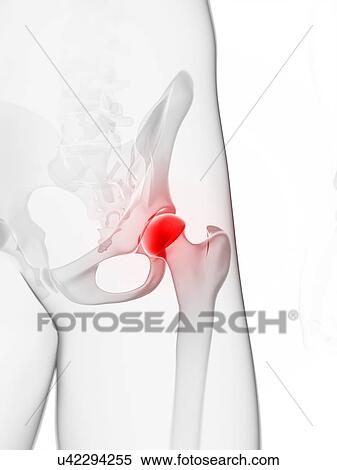 Stock Illustration - Hip pain, conceptual artwork. Fotosearch