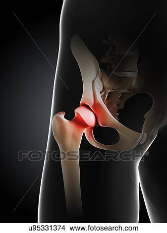 Hip pain, conceptual artwork View Large Illustration Stock Illustration - Hip pain, conceptual artwork. Fotosearch