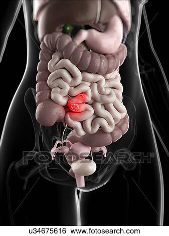 Intestinal cancer, artwork View Large Illustration Stock Illustration - Intestinal cancer, artwork. Fotosearch
