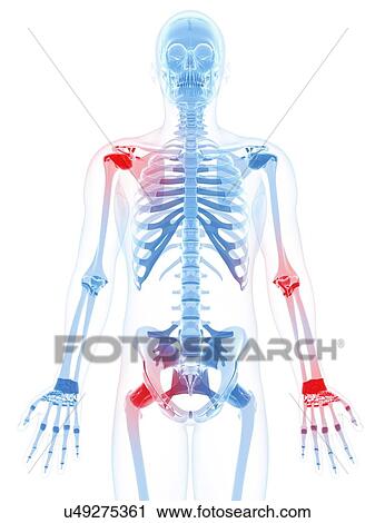 Clip Art - Joint pain, conceptual artwork. Fotosearch