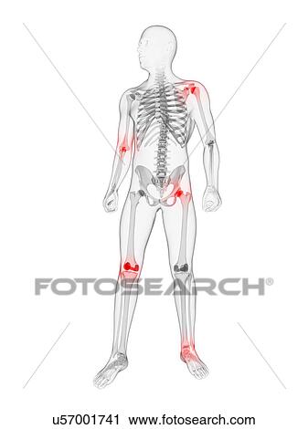 Joint pain, conceptual artwork View Large Illustration Clip Art - Joint pain, conceptual artwork. Fotosearch