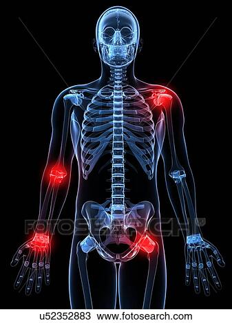 Joint pain, conceptual artwork View Large Illustration Drawing - Joint pain, conceptual artwork. Fotosearch