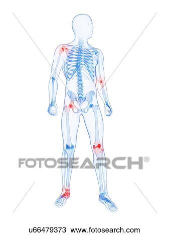 Drawing - Joint pain, conceptual artwork. Fotosearch